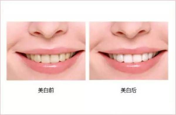 温馨提示 | 双十一再多美衣也难抵一口黄牙