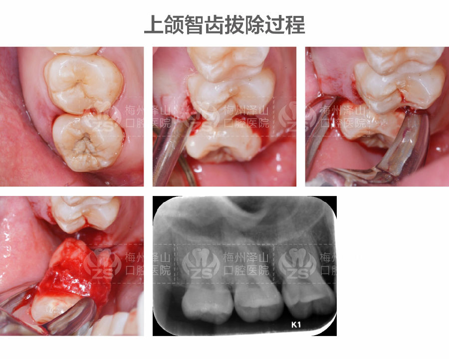 上颌智齿拔除-梅州泽山口腔医院,口腔医院